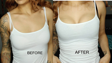 Upbra before and after